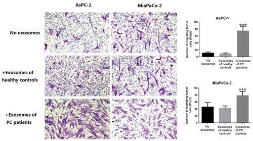 Figure 7 Transwell invasion experiment of Miapaca-2 and Aspc-1 treated with or without exosomes derived from PC patients. As can be seen from the figure, exosomes derived from PC patients can increased the trans magration of PDAC cell lines significantly (***P < 0.001).