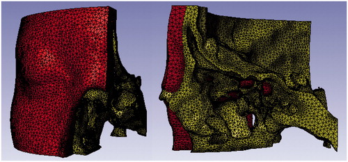 Figure 1. Three finite element models of the orbit were produced and used for analyses. An example model is shown. Each model consists of parts simulating the bone and soft tissues.
