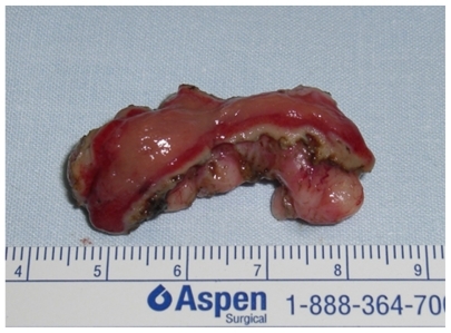 Figure 5 Operative specimen after endoscopic enucleation. The overlying mucosa was resected en bloc.