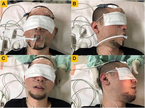 Figure 2 A patient undergoing drug-induced sleep endoscopy in various positions with or without intermittent negative airway pressure (iNAP) therapy.