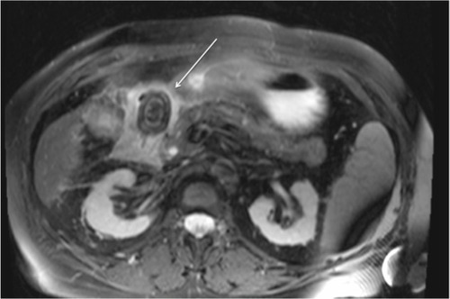 Figure 4 MRI of the abdomen demonstrating a large impacted duodenal gallstone (arrow).