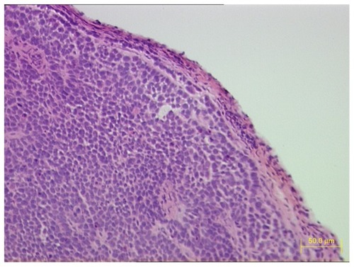 Figure 1 HE staining of tumor tissue sections 3 weeks after BcaCD885 cells were inoculated under the cheek mucosa of nude mice.