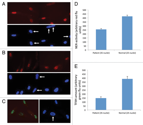 Figure 1. Cell cultures and results. Patient's cells were mixed 1:1 with normal control fibroblasts preloaded with cytoplasmic beads. The mixed cultures were assayed for unscheduled DNA synthesis (A) and recovery from transcription inhibition (B). Red fluorescence shows the NER activity, and blue color reflects the DAPI signal. White arrows indicate the 238DOD cells, as recognized by not containing cytoplasmic beads. (C) Mixed cultures as described for panels A/B,immunostained for TFIIH core component XPB (green fluorescence). (D) Measured NER-activity in TTD238DOD and a control cell line. (E) Measured XPB expression in TTD238DOD and a control cell line