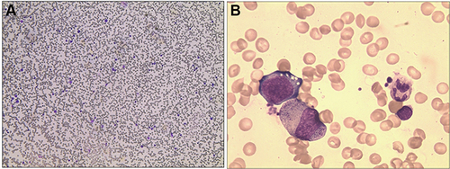 Figure 1 Bone marrow smear showed (A) Actively hypercellular marrow with reduced erythropoiesis; Wright-Giemsa Stain, magnification 100x; (B) Vacuolated pronormoblasts; Wright-Giemsa Stain, magnification 400x.