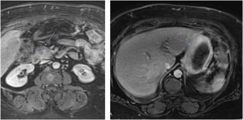 Figure 2. Left: MRI image of solitary 3.5cm mass in uncinate process of pancreas (arrow). Right: MRI image of diffusely thickened stomach wall (arrow).