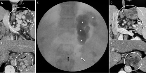 Figure 6 BRTO of a gastrolienorenal shunt in a 48-year-old male.