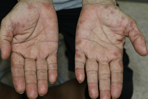 Figure 3 A 68-year-old male with erythematous to brownish annular papules and plaques on the margins of both hands.
