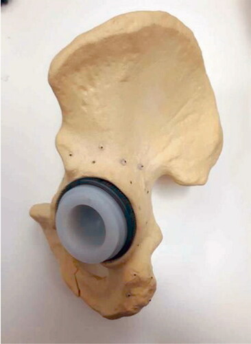 Figure 3. Phantom: sawbone of the hemipelvis, with the Allofit acetabular cup with a polyethylene liner (size 54 cm diameter) with tantalum markers attached around the acetabular bone.