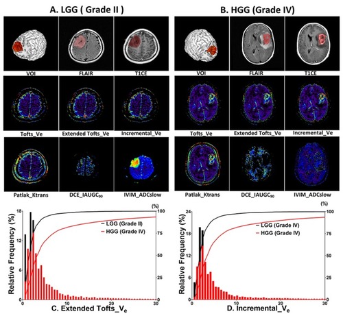 Figure 2 Multi-modal parameter maps and histograms from a representative LGG and HGG patients, respectively. (A) Images of a 45-year-old patient with grade II glioma. The VOI was drawn on FLAIR. (B) Images of a 63-year-old patient with grade IV glioma. The VOI is obtained from FLAIR or T1CE. HGG (B) is associated with increased Tofts_Ve, Extend Tofts_Ve, Incremental_Ve, Patlak_Ktrans and decreased DCE_IAUGC90, IVIM_ADCslow values within the VOI. Histograms and corresponding cumulative curves for Extended Tofts_Ve (C) and Incremental_Ve (D) in patients A and B, showing a left-shifted cumulative curve (smaller mean value) in LGG for both parameters.