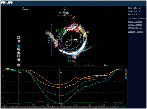 Figure 1. Echocardiographic image demonstrating measurement of basal LV rotation.