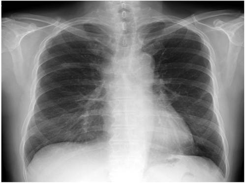 Figure 1 Chest X-ray at the onset of pneumonitis.