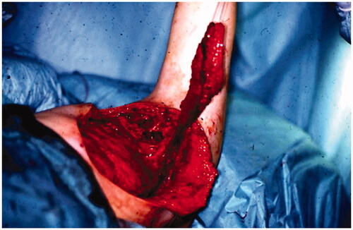 Figure 2. A LD-flap was raised to cover the region of the excised fistula.