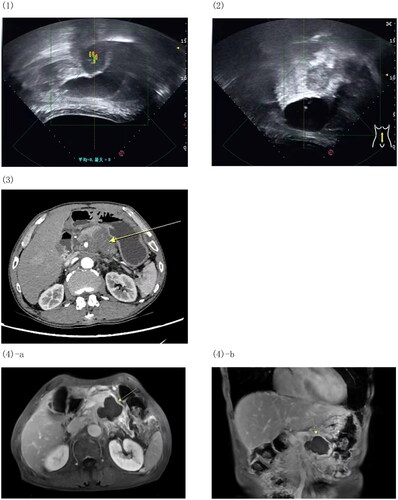 Figure 1. Efficacy of HIFU ablation. (1) Pretreatment ultrasound images. (2) Post-treatment ultrasound image showing overall grey scale changes in the target area. (1) and (2) are taken from the same patient. (3) Pretreatment CT presentation of pancreatic body caudal tumor. (4) Follow-up enhanced MRI after 1 month of treatment, with no enhancement in the area of the lesion (indicated by the arrow) and significant coagulative necrosis of the lesion seen in delayed phase. (3) and (4) are taken from the same patient.