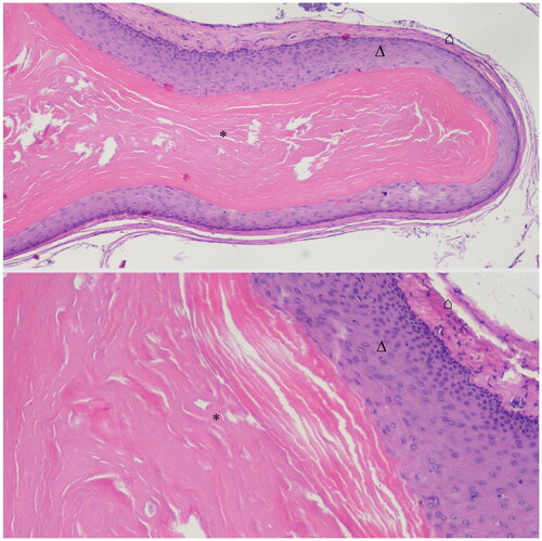 Figure 3. Histological finding of the cyst: Keratin content and trichilemmal keratinization without granular layer (* keratin, Δ keratinocytes, ⌂ fibrous capsule, H&E staining).