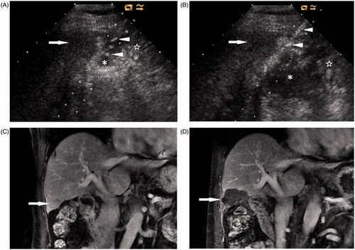 Figure 2. A 73-year-old man with a 2.7-cm HCC in the right lobe of the liver. (A) Ultrasound shows that artificial ascites (*) successfully separates the intestine (☆) from the index tumour (arrow) located at the edge of hepatic segment V. Note the IV catheter (arrowheads). (B) A thermocouple (arrowheads) is placed into artificial ascites (*) between the index tumour (arrow) and the intestine (☆) under ultrasound guidance. (C) Coronal contrast-enhanced MRI before MW ablation shows a tumour (arrow) located at the edge of segment V close to the intestine. (D) Coronal contrast-enhanced MRI 1 month after MW ablation shows the ablation zone (arrow).