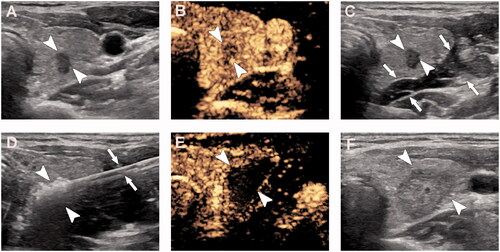 Figure 1. A 35-year-old woman with papillary thyroid microcarcinoma in the right lobe was treated with microwave ablation. (A) Pre-ablation, B-mode ultrasound shows hypoechoic target tumor (arrowheads); (B) Pre-ablation, contrast-enhanced ultrasound shows hypo-enhancement pattern (arrowheads); (C) Hydrodissection technique (arrows) was used to protect the vagus nerve and carotid artery surrounding the tumor (arrowheads); (D) Hyperechoic pattern in the tumor (arrowheads) during ablation (arrows); (E) Post-ablation, the CEUS shows no enhancement (arrowheads) in the tumor; (F) One day post-ablation, US shows the hypoechoic ablation zone (arrowheads).