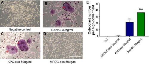 Figure 5 KPC-exosomes induced BMM cells differentiate to osteoclasts. (A–D) Culture in conditioned medium from KPC-exo 50ug/mL promoted the osteoclast differentiation, where MPDC-exosomes did not work and RANKL as positive control, Scale bar, 200 μm. (E) The number of osteoclasts induced by KPC-exo significantly increased ***P < 0.01.