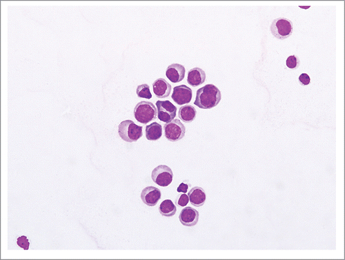 Figure 1. Cerebrospinal fluid (CSF) cytological examination showed presence of abnormal plasma cells featuring enlarged and hyperchromatic nuclei, nuclear contour irregularity and occasional cells with binucleation. (Giemsa stain, original magnification, x 400).