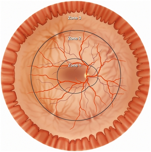 Figure 5 Diagram of the retina shows the three anatomic zones used for classification of CMV retinitis.