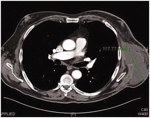 Figure 6. CT scan image 1-month post-resection of chronic seroma capsule and free ALT-flap inset.