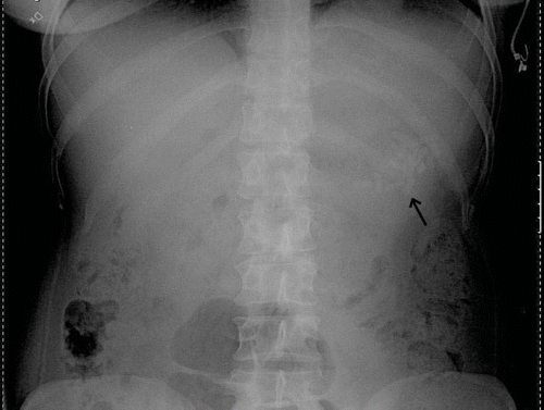 Fig. 1.  Abdominal x-ray of case 1, displaying an aggregate of radio-opaque tablets located in the fundus of the stomach (arrow).