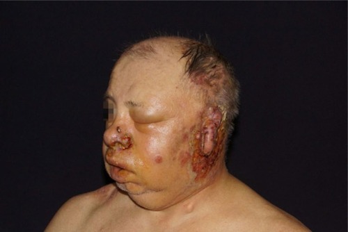 Figure 3 Increased facial edema and necrotic herpes zoster lesions.