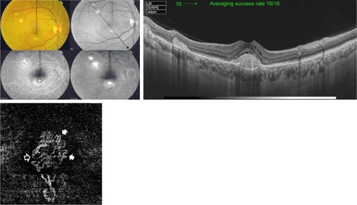 Figure 2 Upper left, color photo, red-free photo, and FFA of the right eye of a 51-year-old female with classic CNV on top of MFC. Upper right, corresponding SS-OCT image in line scan mode shows three hyper-reflective nodular lesions located entirely above the RPE. The sub-foveal lesion resulted in disruption of the outer retinal layers and is associated with overlying intra-retinal edema which indicates type II active CNV. Lower left, “en face” SS-OCTA image of the same eye taken at the level of the outer retina in a 3×3 mm field. The central portion of the lesion demonstrates dense arborization. More peripherally, several vascular anastomosis (closed arrow heads) and looping (open arrow head) are shown.