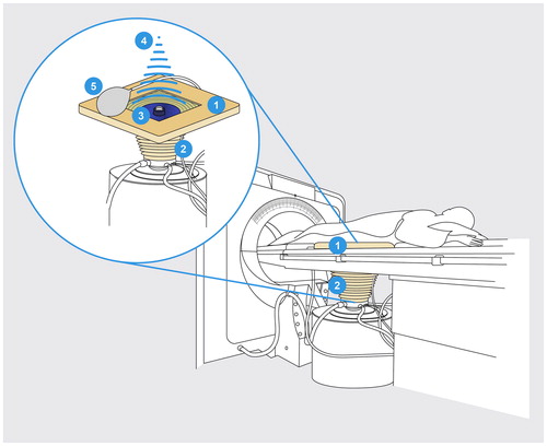 Figure 2. US-guided HIFU system: schematic drawing of the US-guided HIFU unit JC Tumor Therapeutic System (HAIFU Medical Technology, Chongqing, China). Patients with uterine fibroids are positioned prone on the treatment table where there is an opening (1) with a water basin (2). Patient’s skin of the lower abdominal wall over the uterus is at the level of this opening, thus the skin is in contact with cooled water. The parabolic therapeutic transducer (3) with the convex diagnostic ultrasound probe in the center is located in this water basin. The therapeutic ultrasound beam (4) is transmitted by a 20 cm diameter ceramic transducer with a focal length of 15 cm, operated at a frequency of 0.8 MHz. To compress the subcutaneous tissue and dislocate the bowel away from the acoustic path, a balloon filled with degassed water (5) is positioned between the transducer and the skin resp. anterior abdominal wall. During HIFU procedure, the extracorporeal therapeutic transducer (3) generates an ultrasound beam (4) forming an oval-shaped focus sized 1–3 mm in width and 8–15 mm in length. This way a lesion of coagulation necrosis can be induced in the target area. In case of visible grey-scale changes in the target area suggesting effective ablation, the transducer is moved to the next focus. Multiple juxtaposed lesions generate linear and discoidal necrosis areas and finally allow the ablation of the whole tumor area.