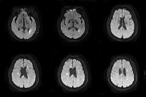 Figure 2 Typical neuroimaging of a patient with acute Ischemic stroke and active tuberculosis meningitis. Images are from a male in his 50s who had acute Ischemic stroke without conventional stroke risk factors and who was initially diagnosed with active tuberculosis meningitis during the treatment of Ischemic stroke. Six MRI diffusion-weighted images show multiple high-signal lesions in multiple arterial regions of the brain.