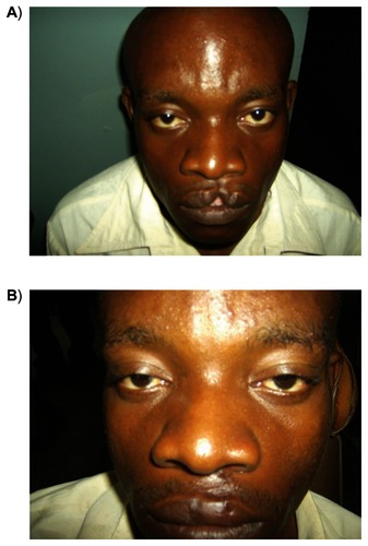 Figure 4 Repair of an incomplete cleft of the lip using Tennison–Randall triangular technique under local anesthesia: A) preoperative appearance; B) postoperative appearance.