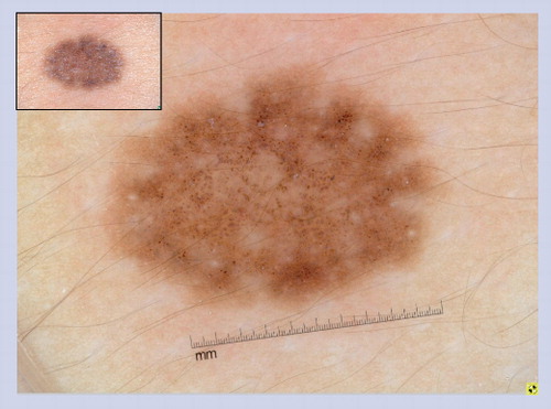Figure 1. Congenital melanocytic nevus.The congenital melanocytic nevus displays an organized and symmetric pattern with a peripheral network pattern with central globules. The lesion also has a few milia cysts and hypertrichosis, which are structures commonly observed in congenital melanocytic nevus.