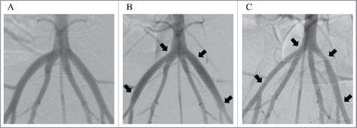 FIGURE 1. Digital subtraction angiography images of the porcine iliac arteries before stent implantation (A), immediately after stent implantation (B) and 6 weeks after stent implantation (C). The Igaki-Tamai stent was placed in the right iliac artery, and a bare metal stent was placed in the left iliac artery. Each arrow shows an edge of the implanted stents.