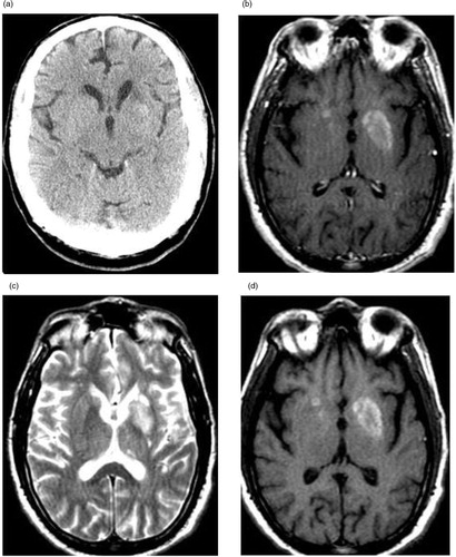 Fig. 1 (a) Non-contrast CT scan showing ill-defined hyperdensity in left putamen. (b) Axial T1-W without contrast showing hyperintensities in bilateral putamen and caudate. (c) Axial T2-W without contrast showing corresponding hypointensities in putamen and caudate. (d) Axial T1-W with contrast showing no enhancement of abnormal signals after gadolinium.