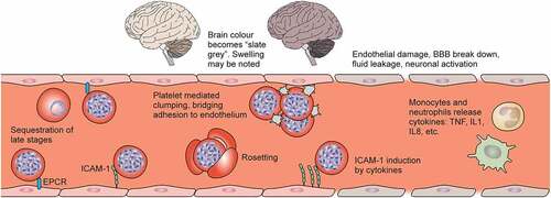 Figure 2. Sequestration in Plasmodium falciparum. Reading left to right, the brain colour changes from light tan to a “slate grey” colour in cases of fatal cerebral malaria. Mature infected erythrocytes (IEs) sequester in the deep vasculature, including cerebral vessels. Receptors on endothelial cells include endothelial protein C receptor (EPCR), ICAM-1 and heparan sulphate proteoglycans. Platelets can clump IEs, and bridge between CD36 binding IEs and endothelium. IE can activate monocytes and neutrophils to release cytokines and immune mediators, which can upregulate ICAM-1 expression, and induce damage to the blood–brain barrier. Fluid leakage through and between cerebral endothelial cells can lead to neuronal activation and may result in potentially fatal brain swelling, associated with brain discolouration.
