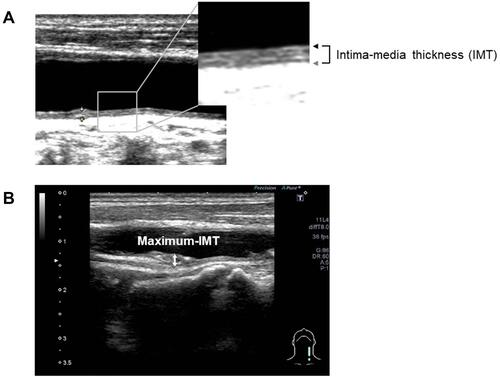 Figure 2 Longitudinal B-mode ultrasonographic images of the common carotid artery. (A) IMT was determined as the distance between the lumen-intima interface (black arrow) and the media-adventitia interface (gray arrow). (B) Maximum IMT was recorded as the largest IMT value measured on both sides of the common carotid artery, bifurcation, and internal carotid artery (two-headed arrow).