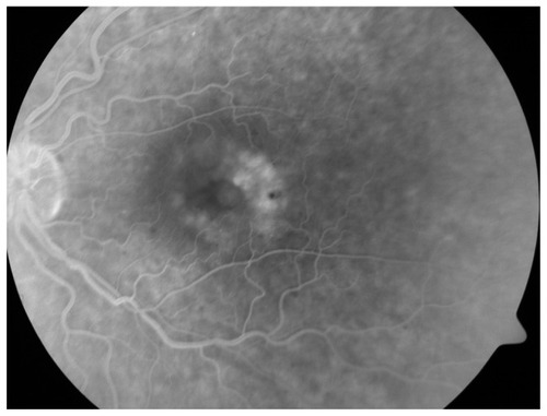 Figure 2 Fluorescein angiogram of the left eye showing cystoid macular edema, particularly in the temporal quadrant of the fovea.