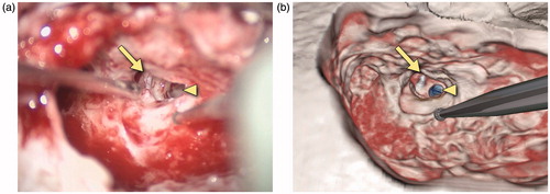 Figure 11. Snapshots comparing the actual (a) and virtual (b) procedures for a 20-year-old man who presented with progressive bilateral sensorineural hearing loss and was deemed a good candidate for cochlear implantation. The operative photograph shows the mastoidectomy and facial recess approach during cochlear implant insertion on the right. The arrow identifies the capitulum of the stapes in the middle ear while the triangle shows the location of the cochleostomy through which the cochlear implant electrode is inserted. In the simulation view, the cochlea has been segmented in blue.