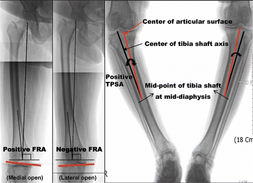 Figure 1. Full-length weight-bearing AP radiographs showing the measurement of the femoral resection angle (FRA) and the tibial plateau shift angle (TPSA) to determine the coronal plane anatomic variations of the distal femur and proximal tibia, which include a negative FRA (lateral open) and/or positive TPSA (>2°, lateral shift of tibia shaft axis).