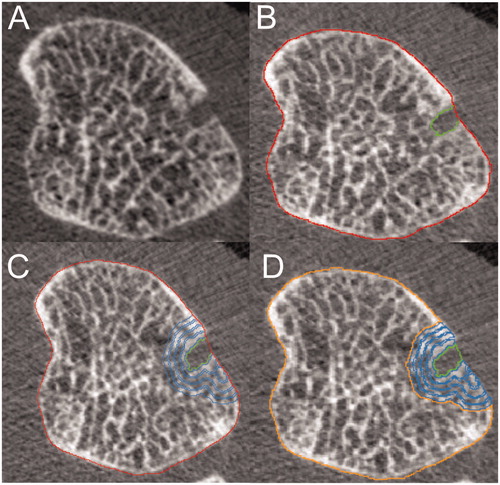Figure 3. HR-pQCT scan of a 2nd metacarpal head of a patient with rheumatoid arthritis in an axial plane. (A) Erosion at quadrant IV; (B) MIAF bone segmentation as a continuous line around metacarpal head and erosion segmentation as a line inside metacarpal head; (C) Four different layers of bone mineral density (BMD) values around erosion (lines around bone erosion) provided by Medical Image Analysis Framework (MIAF); (D) BMD of total metacarpal head (MCP) analyzed by MIAF as a continuos line at the edge of metacarpal head and without the area around the bone erosion.