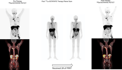 Figure 7. PRRT in case of metastatic Medullary Thyroid Cancer.