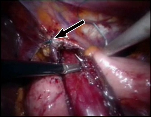 Figure 2 A hiatal repair (arrow) and cardiomyotomy were performed.