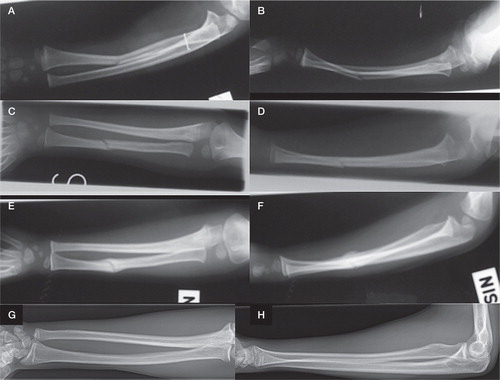 Figure 1. An illustrative series of radiographs taken from a case who participated in the study. A 4-year-old boy suffered from a left-side both-bone forearm shaft fracture in the middle third. A. and B. There was a greenstick fracture in the radius and plastic bowing in the ulnar shaft. C. and D. 3 weeks after closed reduction and cast immobilization, the forearm presented good alignment in 2 directions. Slight malalignment remained in the bowed ulna. E. and F. 6 weeks after the injury, free mobilization was allowed. However, worsening alignment with both posterior and radial angular curvatures in the radius was seen (panel F). G. and H. Long-term radiographs 11 years after the injury show good alignment without any other bone complication. The remaining lateral bowing of the radius does not exceed 15° and is consistent with anatomic variation (panel G).