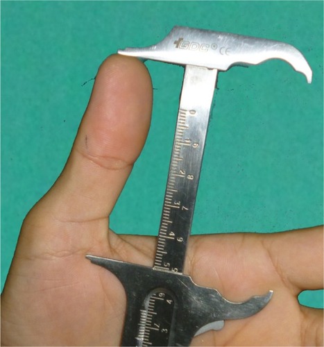 Figure 1 Measurement of thumb length.