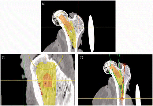 Figure 2. (a) Mediolateral stem alignment in the anteroposterior view was defined as the angle between the medial margin of the stem and the anatomical axis of the femur. (b) Anteroposterior stem alignment in the lateral view was defined as the angle between the anterior margin of the stem and the anatomical axis of the femur. (c) Vertical seating of the stem was defined as the distance from the apex of the greater trochanter to the distal tip of the stem.