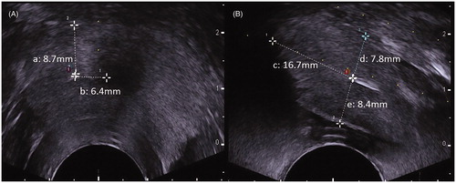 Figure 1. The position and orientation of the laser applicator on transrectal ultrasound images (A, transverse section; B, longitudinal section). The distances from the tip of the laser applicator to prostatic capsule (a, d), the outer wall of the urethra (b), the rectum wall (e), and the bladder floor (c).