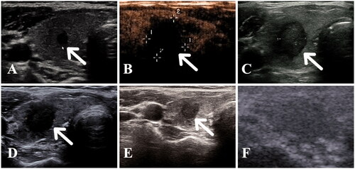 Figure 2. A 60-year old woman with a papillary thyroid carcinoma in the middle of the left thyroid lobe (A) A hypoechoic nodule (white arrow) with an irregular margin was detected in the middle of the left thyroid lobe. (B) Immediately after radiofrequency ablation (RFA), a non-enhanced area measuring 1.4 × 1.4 × 1.4 cm was observed in the ablation zone. (C–E) Follow-up images showed that the ablation zone decreased gradually to 1.1 × 1.1 × 0.8, 0.9 × 1.0 × 0.8, and 0.6 × 0.7 × 0.5 cm at 1, 3 and 6 months, respectively. (F) At 12 months after RFA, the ablation area had disappeared on ultrasonography.