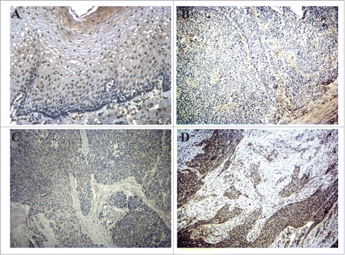 Figure 2. KLF4 is lost in esophageal squamous cell dysplasia and early ESCC but not in advanced ESCC. (A) In normal esophageal squamous epithelium, immunohistochemistry demonstrated brown KLF4 staining predominantly within the suprabasal layer. (B-C) KLF4 staining by immunohistochemistry was nearly absent from esophageal squamous cell dysplasia (B) and early stage ESCC (C). (D) In more advanced ESCC, KLF4 staining was prevalent. Magnification = 100x.