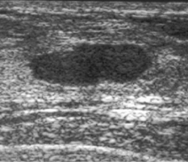 Figure 1. Ultrasonogram of the right breast demonstrates well-circumscribed hypoechoic mass against a background of echogenic stroma.