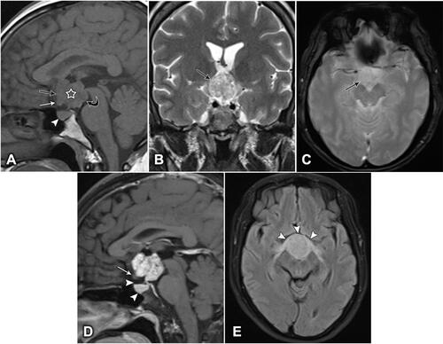 Figure 2 Brain MRI of a 46-year-old woman, showing a lobulated, contoured, solid mass. (A) Mid-sagittal T1-weighted image showing a hypointense lesion (white star), expanding into the supraoptic recess (black arrow), bowing the floor of the third ventricle (curved arrow), pushing the optic chiasm downward and forward (white arrow), and the pituitary gland remains intact (white arrowhead). (B) Coronal T2-weighted image showing a heterogeneous, hyperintense lesion (arrow). (C) Axial T2-weighted image showing no intratumoral calcification (arrow). (D) Sagittal T1-weighted image, post-contrast, showing vivid heterogeneous enhancement. The optic chiasm is compressed downward and forward (white arrow), and the suprasellar cistern and the pituitary gland are intact (arrowheads). (E) Axial fluid-attenuated inversion recovery (FLAIR) image showing the anterior deviation and edema of the optic chiasm (arrowheads).