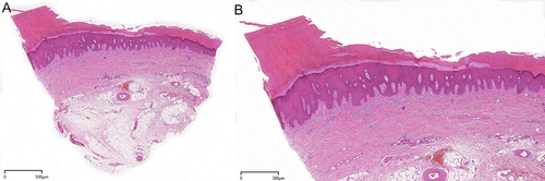 Figure 3 Histopathology of a plaque on the hand knuckle. (A) Hematoxylin-eosin (H&E) staining shows compact hyperkeratosis, epidermal hyperplasia, elongation of rete ridges and subdermal fibrous tissue hyperplasia (original magnification: 20×). (B) H&E, at a higher magnification of Figure 3A (original magnification: 40x).